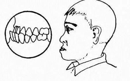幼儿地包天矫正最佳时间,地包天最佳适合纠正时间