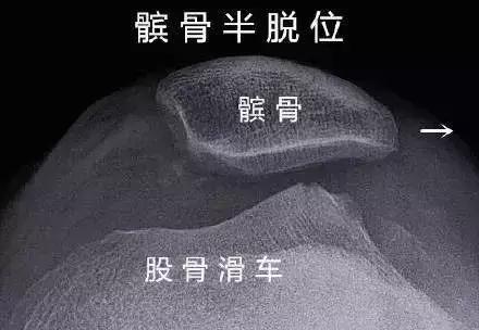 髌骨脱位了怎么办？！康复练习法有哪些（图文解说）