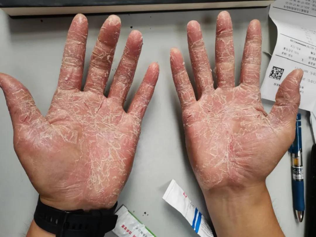 皮肤湿疹的中医辨证论治,皮癣湿疹用什么药膏