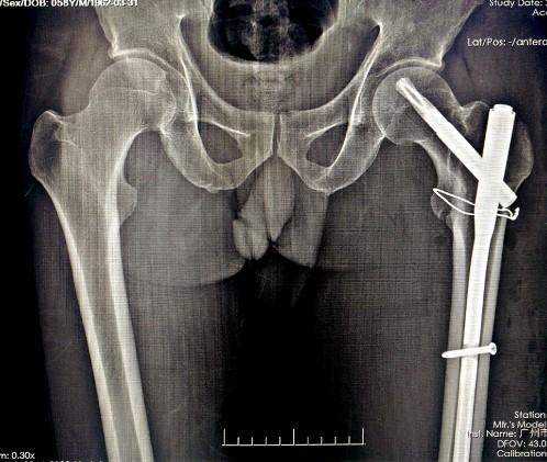 髋部骨折危害大老年人摔伤要重视,髋部骨折的最简单方法