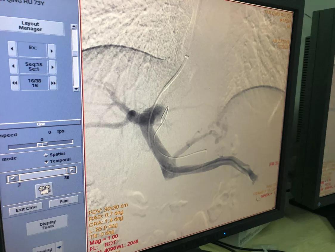 中医治疗肝硬化消化道出血,出奇制胜完整版