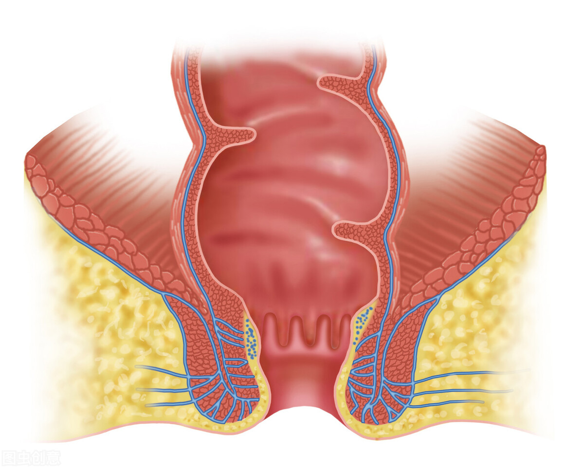 肛周脓肿引流和挂线哪个疼,做过肛周脓肿手术钻心的疼