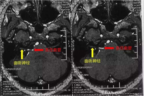 张医生治病救人后续,左眼皮一直跳咋回事好像痉挛