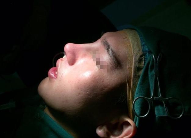 假体隆鼻能保持多久来了解一下,龚忠华整形