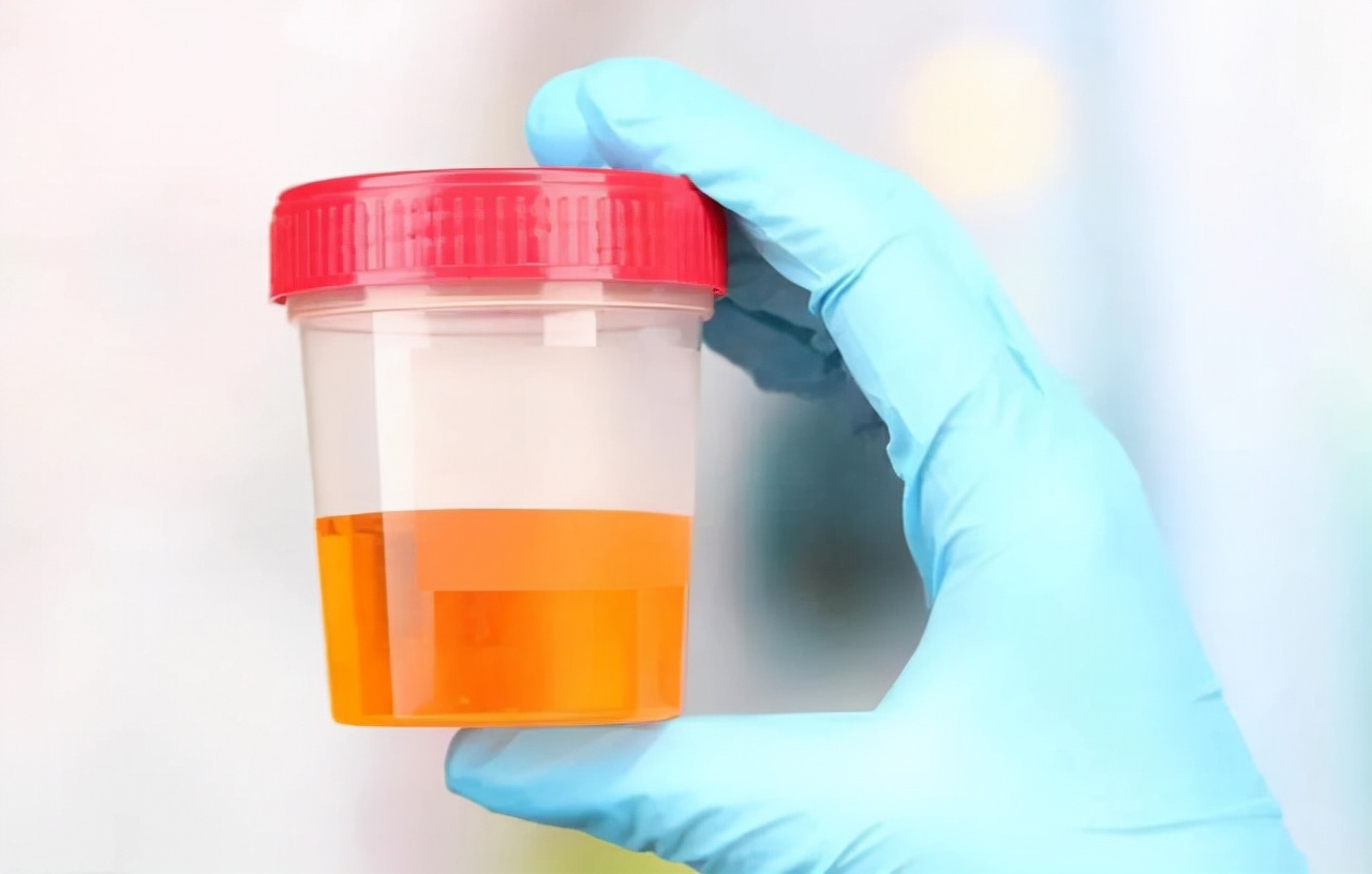 一喝水就尿急是阴虚还是阳虚,一喝水就尿多是肾虚的表现吗