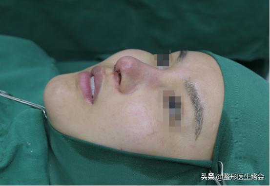 做的耳软骨鼻塌下去了怎么修复啊,做了耳软骨鼻如何不塌