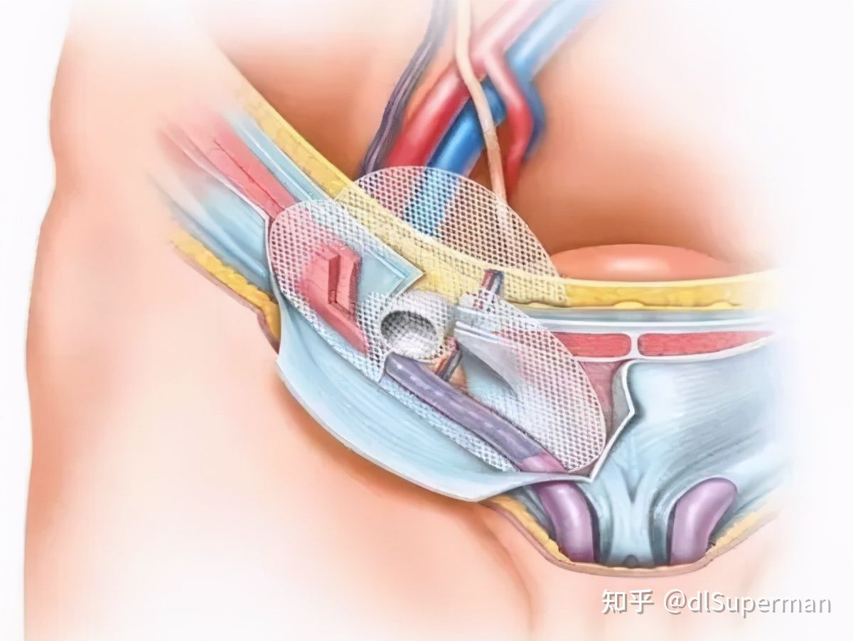 腹股沟疝术后要注意什么,孩子有腹股沟疝应该注意什么