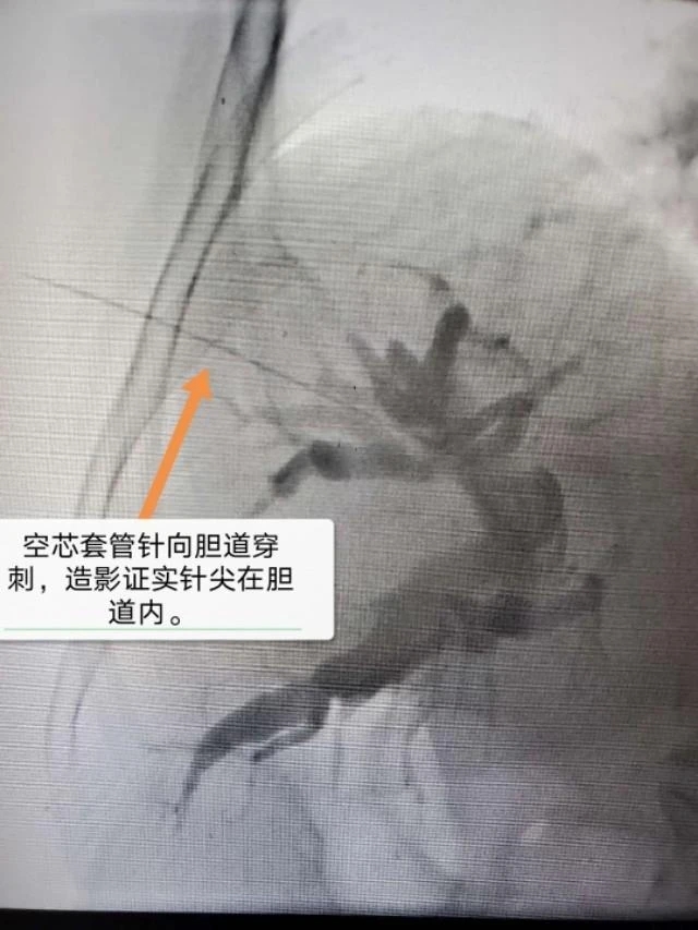 92岁老人多病缠身又遇高热腹痛,大人高热不退怎么处理治疗