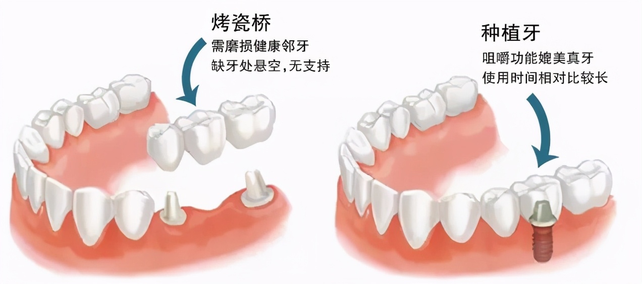 牙坏了怎么办？种植牙原来还有这些“讲究”！