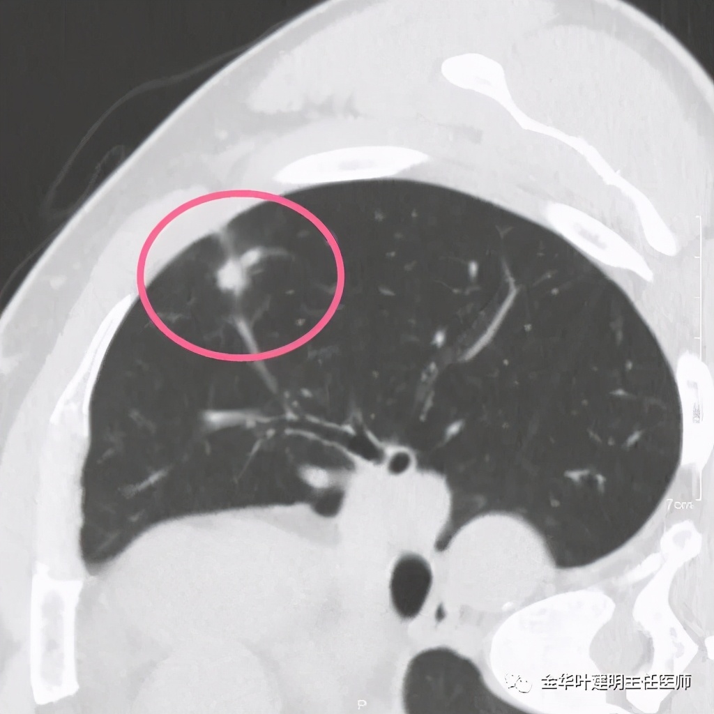 叶建明谈肺结节:一招分辨隐球菌性肉芽肿与肺癌