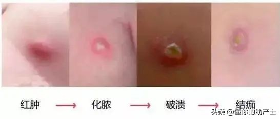 胳膊上莫名其妙的长疤怎么来的,胳膊上长的像疤一样的东西是什么