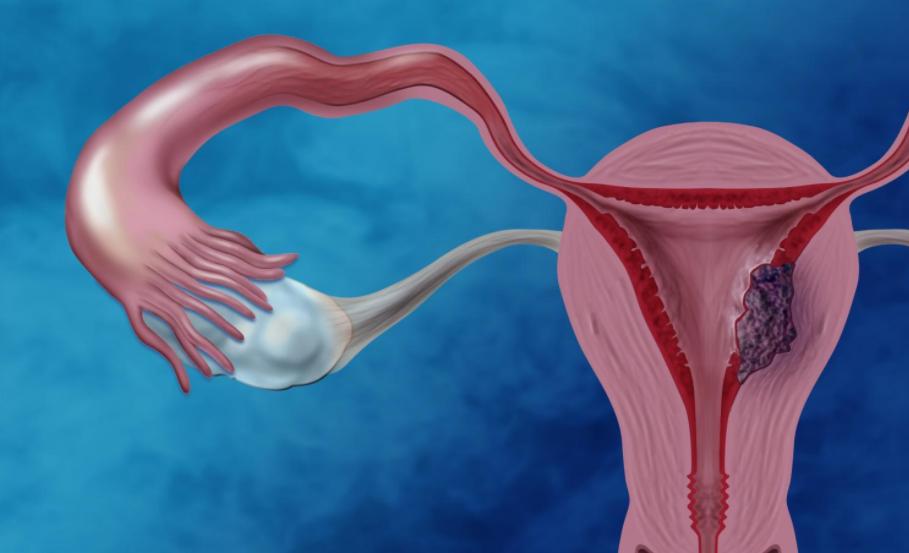 25岁女子怀孕8个月被查出肿瘤,23岁女孩被确诊宫颈癌完整版