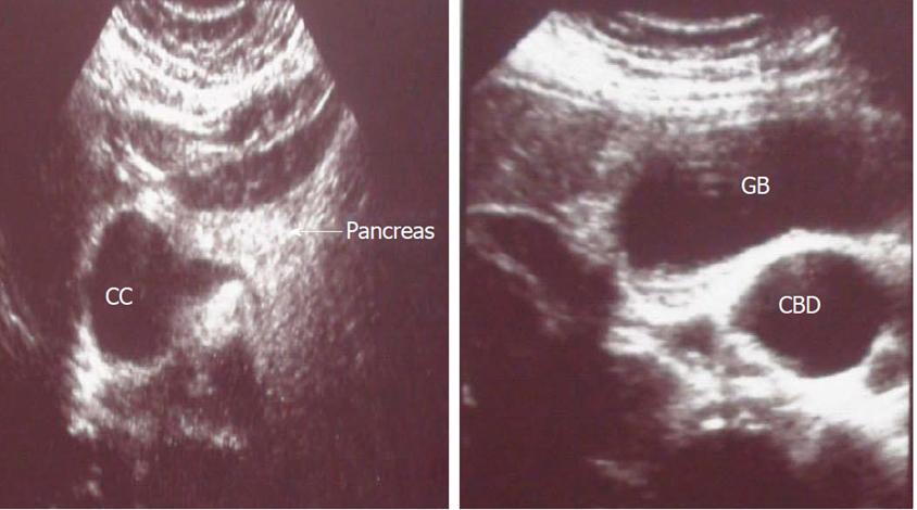 年轻女性反复肚子疼、黄疸、发热，仅仅是胆结石那么简单吗？