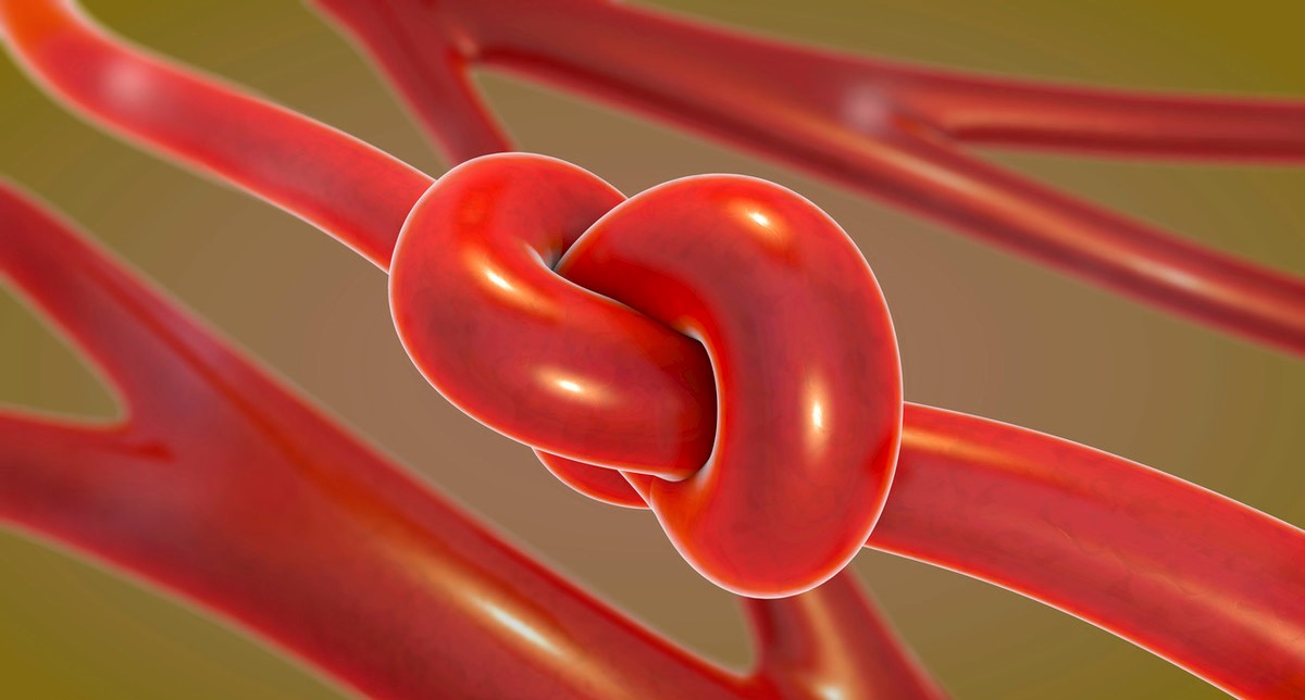 有颈动脉斑块能长期吃他汀类药吗,颈动脉有斑块需要长期吃他汀药吗