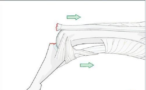 打篮球杵了下手指头,医生告诉要做手术?该不是小题大做吧