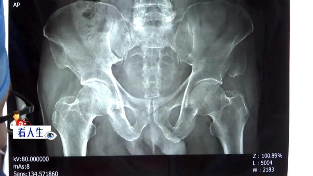 七旬老人被卡车撞伤,老人闯入货车视线盲区死亡被推倒