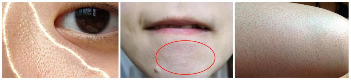 长汗毛导致的鸡皮肤怎么办,女生有鸡皮肤的解决方法