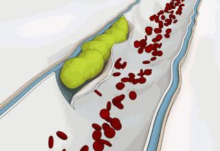 心肌梗塞中药调理好还是西药好,心肌梗塞喝汤药管用吗