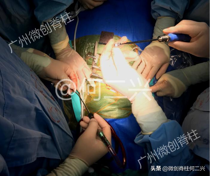 脊柱外科微创手术全过程,胸椎后纵韧带骨化症微创手术