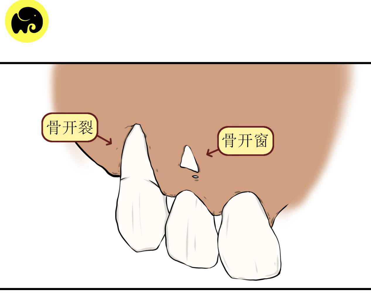 牙齿外伤接近牙龈部有个横的裂纹,牙齿怎么冲破牙槽骨长出来的