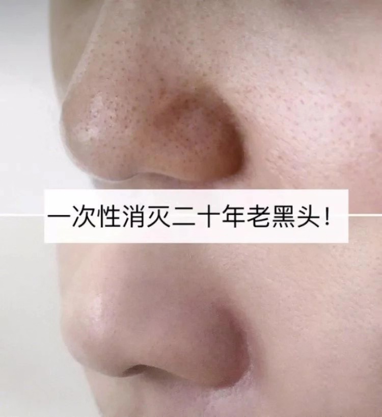 一秒去黑头去粉刺,一步就能搞定的黑头