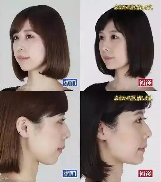 日本整容真的亚洲最好吗？流水线or独家定制，带你看日本整容业