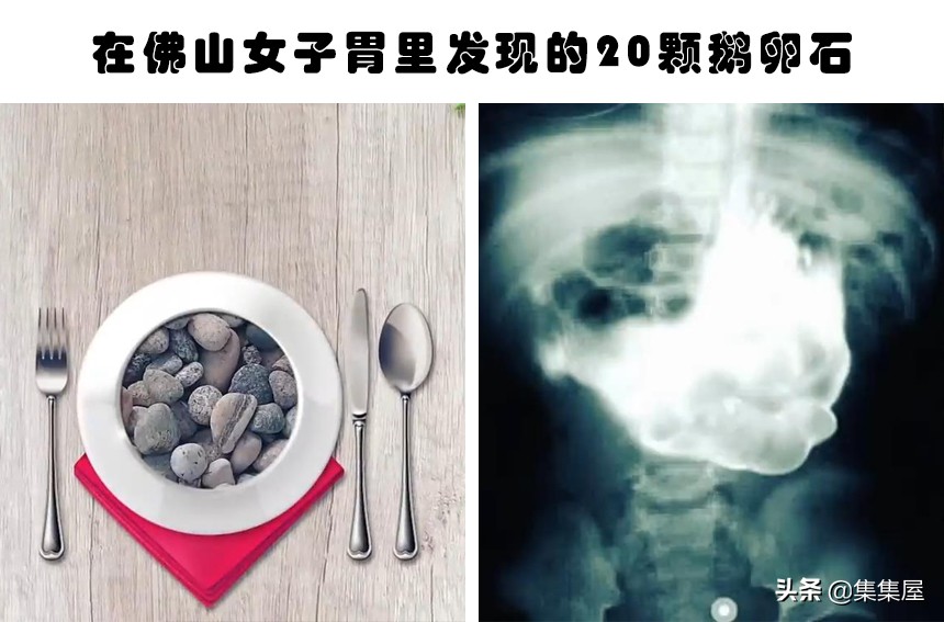 在人体内发现的6个难以用常理解释的物体