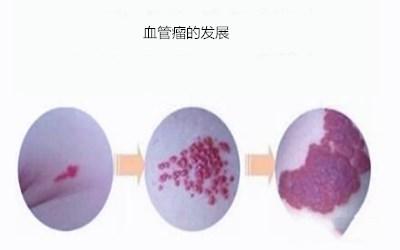 浅表性血管瘤用眼药水能治好吗,什么眼药水可以祛血管瘤