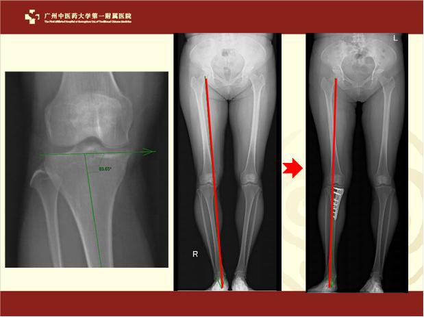 膝骨关节炎阶梯治疗方案,骨关节炎的阶梯治疗是什么
