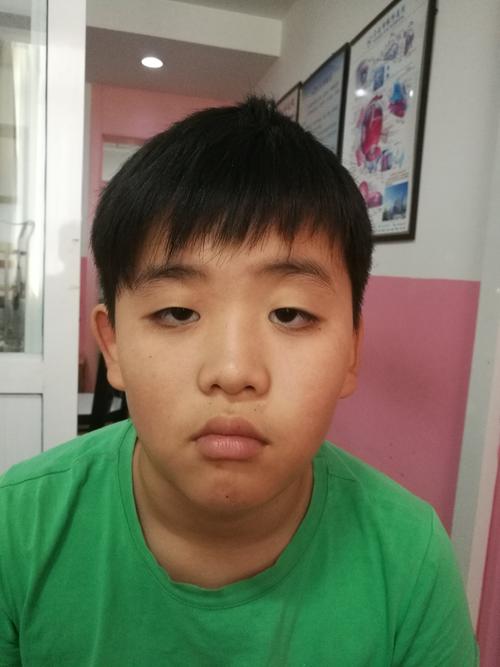 家长们注意：儿童上睑下垂，不能忽视！