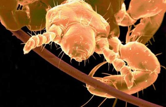 去头发虱子与虱子卵最有效方法,去除头上虱子和虱子卵最好小窍门