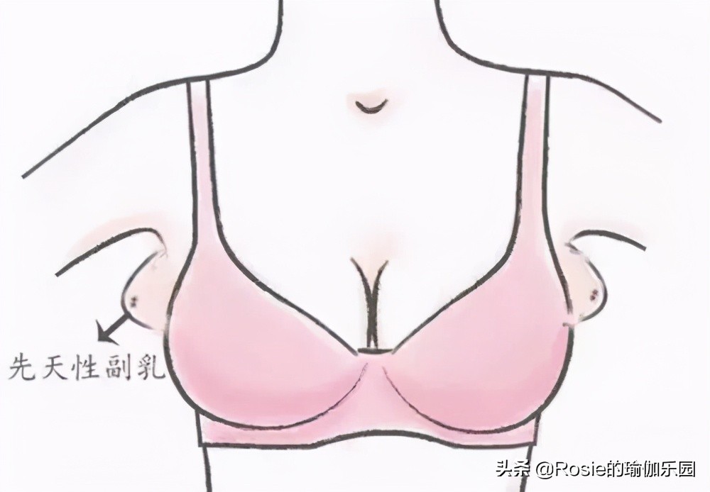 消除副乳斜方肌拜拜肉,副乳粗臂厚肩怎么减