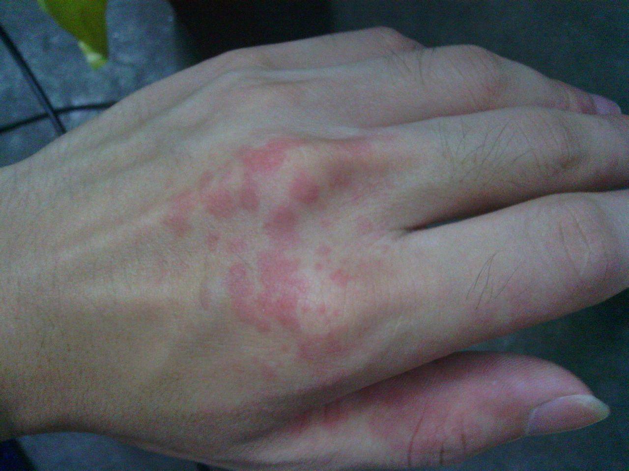 皮肤上有小黑点点是皮肤癌吗,癌症身上起小红点很痒图片