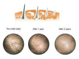 米诺地尔脱发女士专用,米诺地尔对于m型脱发非常有效果