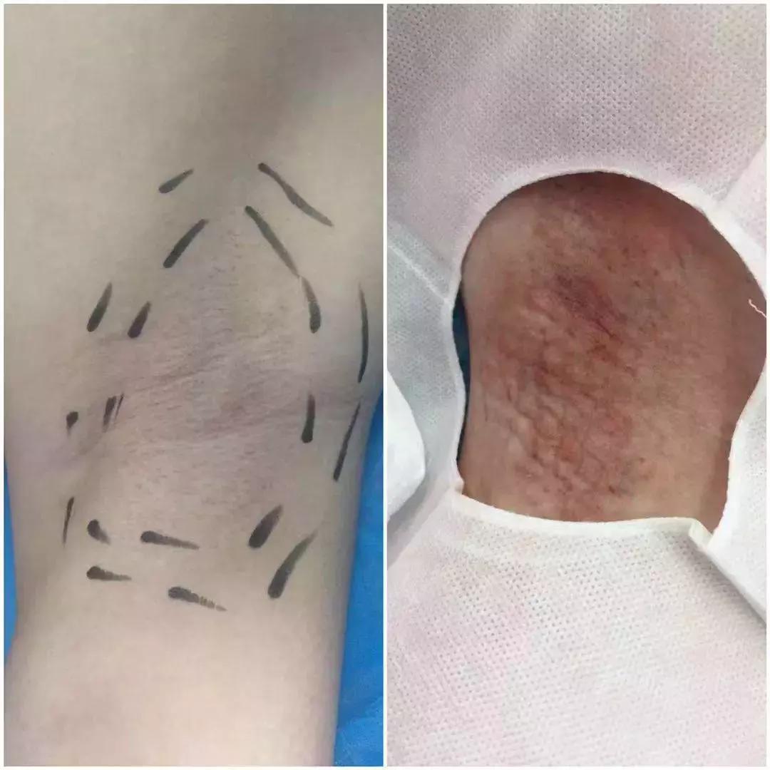 我在新乡二院找到了“针”爱