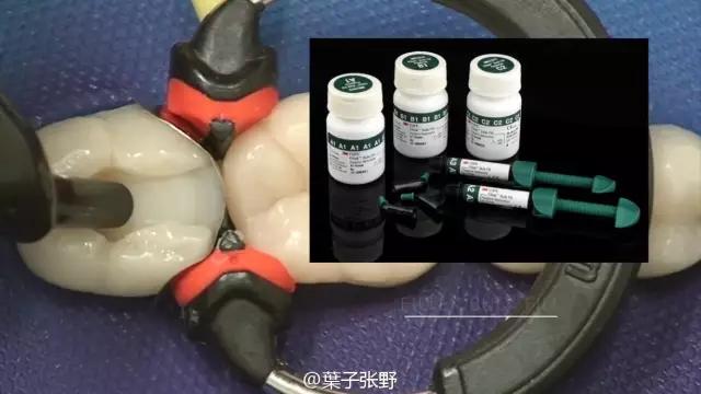 补牙疼吗补牙过程图,补牙全部过程是什么样子的