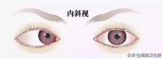 儿童十五岁斗鸡眼能治好吗,五岁儿童眼睛偶尔斗鸡眼怎么回事