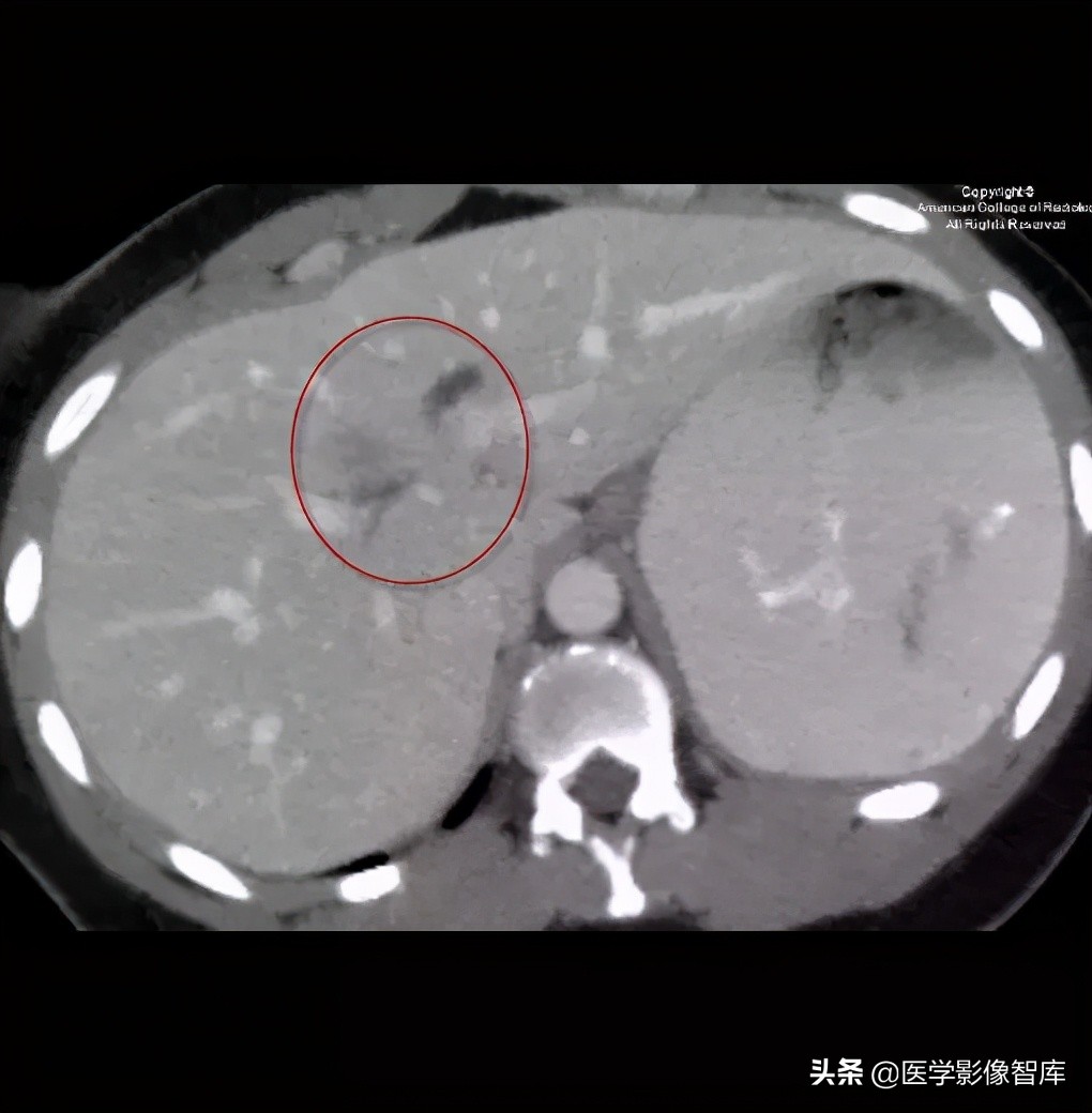 先天性无阴道综合征的影像诊断