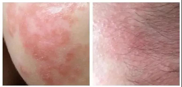 现在宝宝背上有痱子怎么办,宝宝脸上和脖子上全是疹子