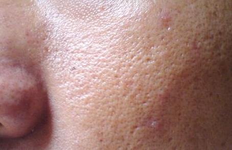 脸颊两边有螨虫用什么东西,螨虫在脸上分泌的物体