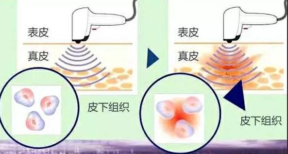 科普|光子嫩肤全攻略，做了光子后禁忌事项有哪些？