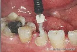 纤维桩修复费用,纤维桩修复全过程视频