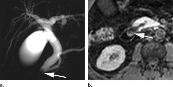 急性胰腺炎和慢性胰腺有什么症状,胰腺炎合并胰腺肿物