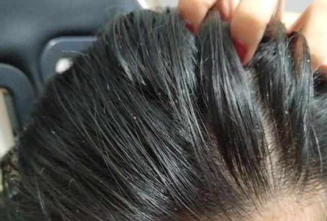 女子用硫磺皂洗三个月的头,女子坚持半年硫磺皂水洗头