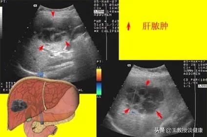 肛周脓肿是不是糖尿病引起的,脓肿为什么会有硬结