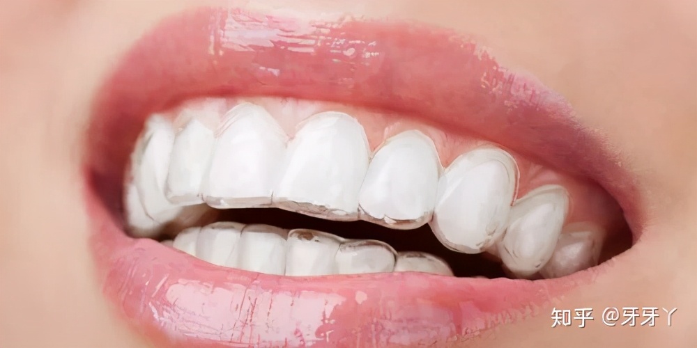 牙齿矫正后保持器一般戴多久,牙齿矫正结束后保持器需要戴多久