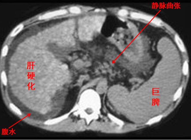 引起脾亢的原因,脾亢一定要切除吗