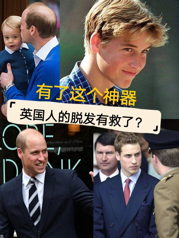有了这个神器,英国人的脱发有救了?