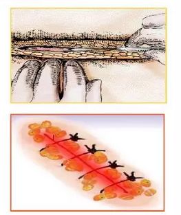 手术成功但感染了是医院的责任吗,切口感染的正确处理方法