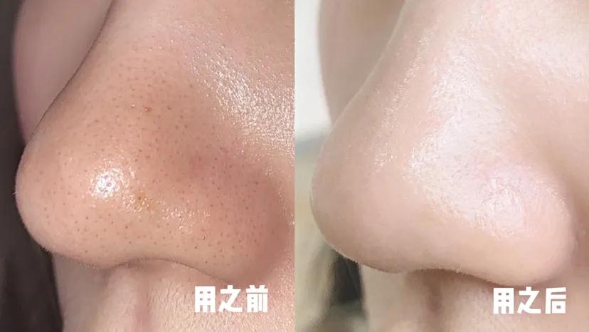 黑头终结者！攒了15年黑头连根拔起，鼻子比钱包还干净